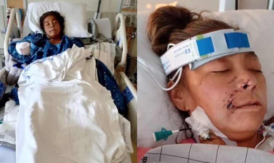 Oklahoma Woman Loses Both Arms and Legs in Vicious Dog Attack: A Heartbreaking Story of Survival