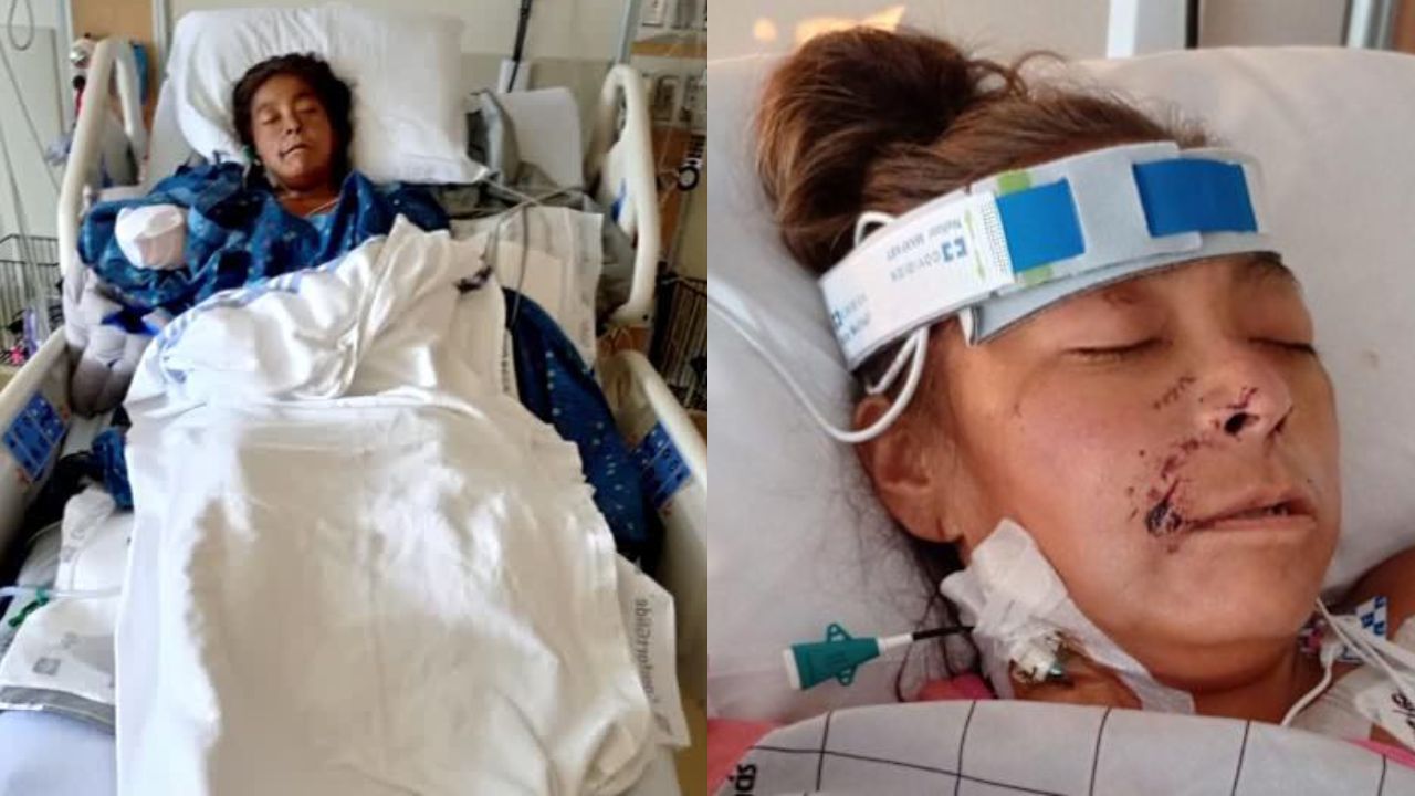 Oklahoma Woman Loses Both Arms and Legs in Vicious Dog Attack A Heartbreaking Story of Survival