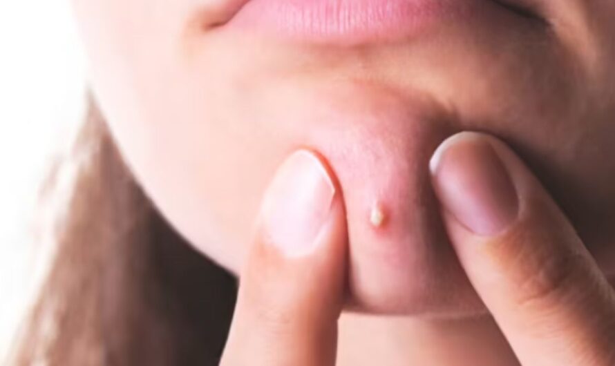 Louisiana Bartender’s Pimple Turns into Dangerous ‘Triangle of Death’ Infection – Urgent Warning