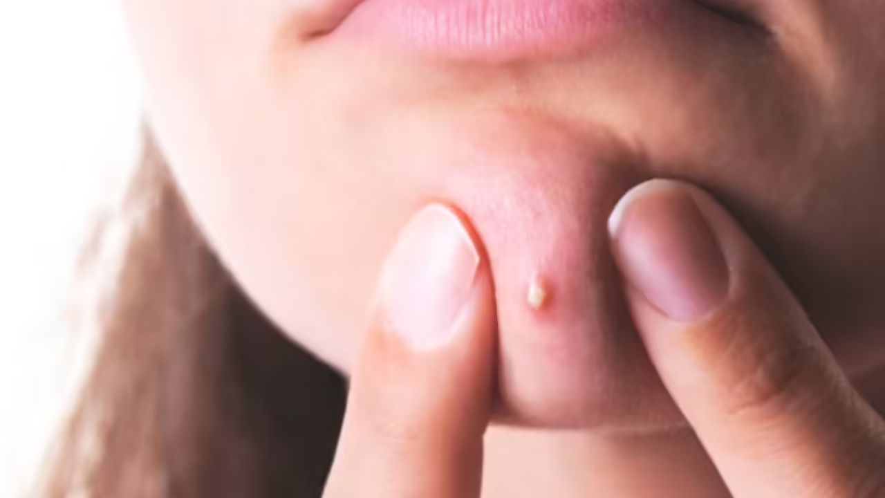 Louisiana Bartender's Pimple Turns into Dangerous 'Triangle of Death' Infection - Urgent Warning